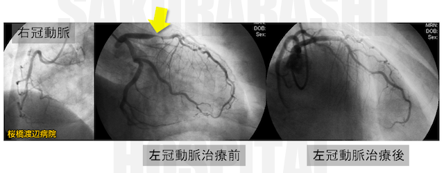 選択的冠動脈造影（CAG）と冠動脈形成術直後の造影